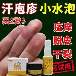 手癣用什么药（儿童手癣用什么药）-图3