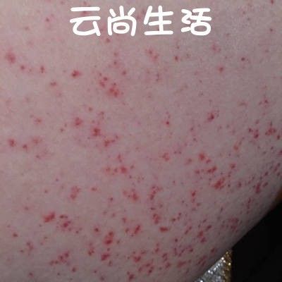 臀部癣用什么药（臀部皮肤癣）-图3