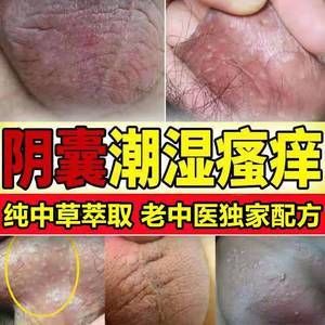 阴茎有灼热感用什么药的简单介绍-图3