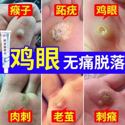 长脚鸡眼用什么药（长脚鸡眼用什么药膏最好）-图2