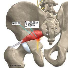 梨状肌综合症吃什么药（梨状肌综合症吃什么药好用）-图2