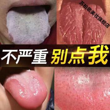 粘膜白斑用什么药（黏膜白斑能自愈吗）-图2