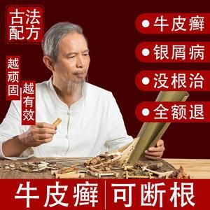 牛皮顽癣用什么药（牛皮顽癣特效偏方草药）-图1