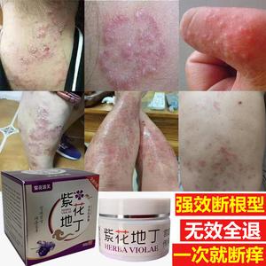 腿部湿疹用什么药（腿部湿疹用什么药好）-图3