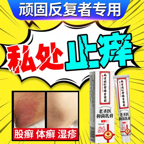 大腿根部痒吃什么药（大腿根痒用什么药膏）-图3